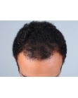 Before Hair Transplant&nbsp;Front
